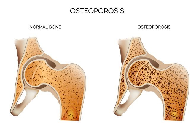 Osteoporosis in Older Adults